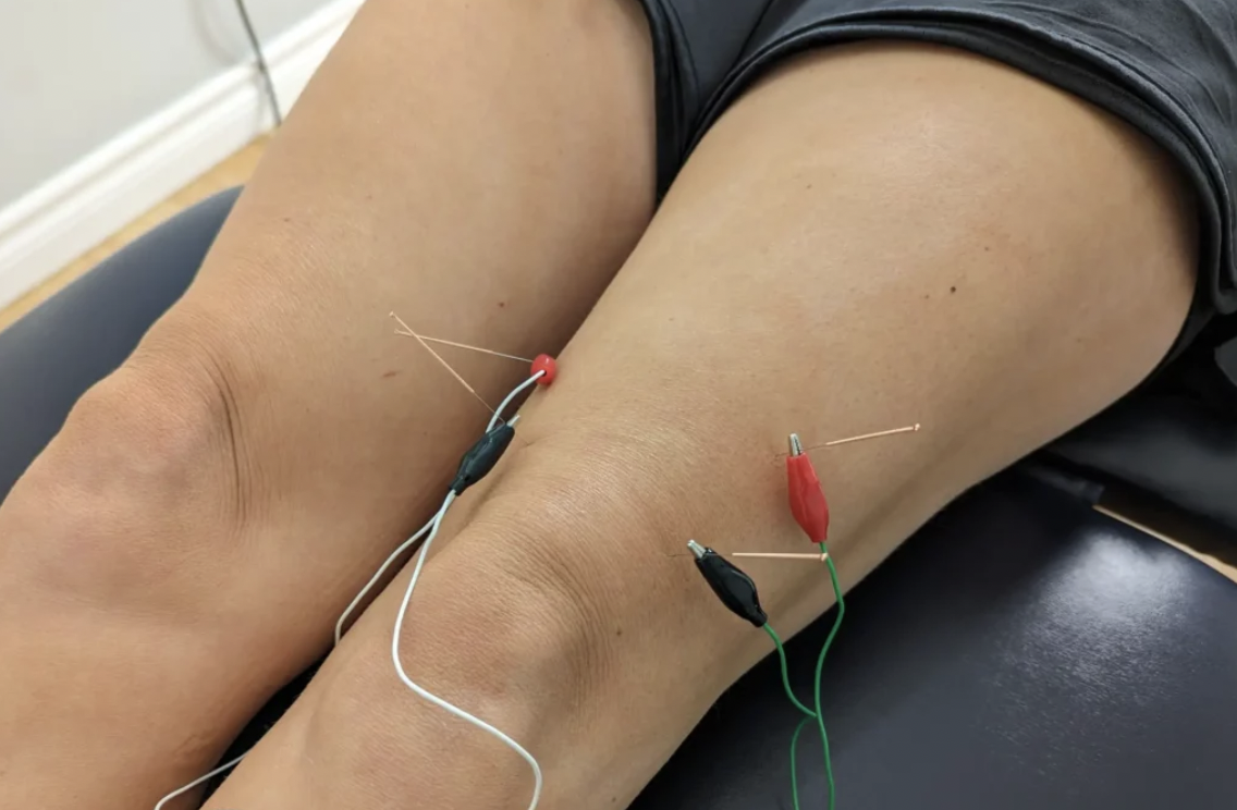 knee elctro acupuncture