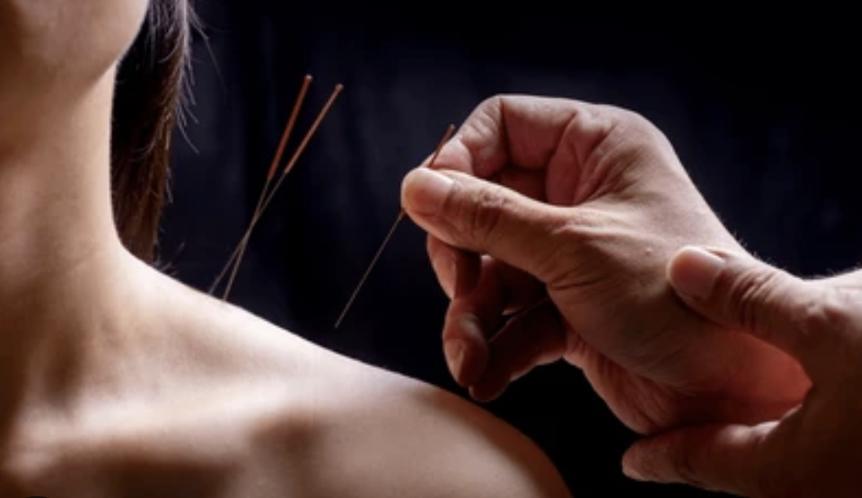 acupuncture needles in shoulder